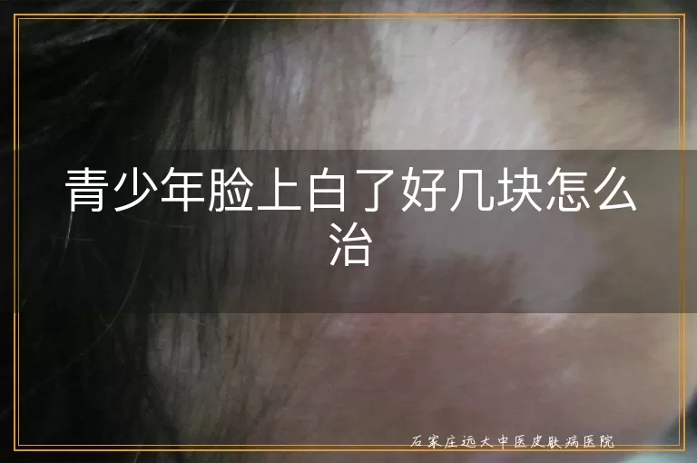 青少年脸上白了好几块怎么治