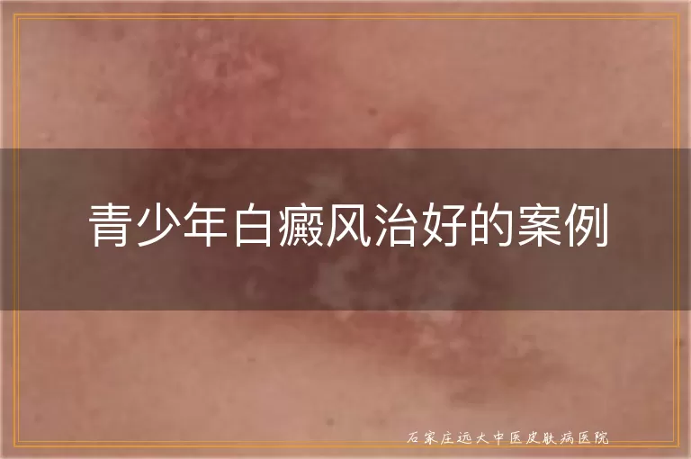 青少年白癜风治好的案例