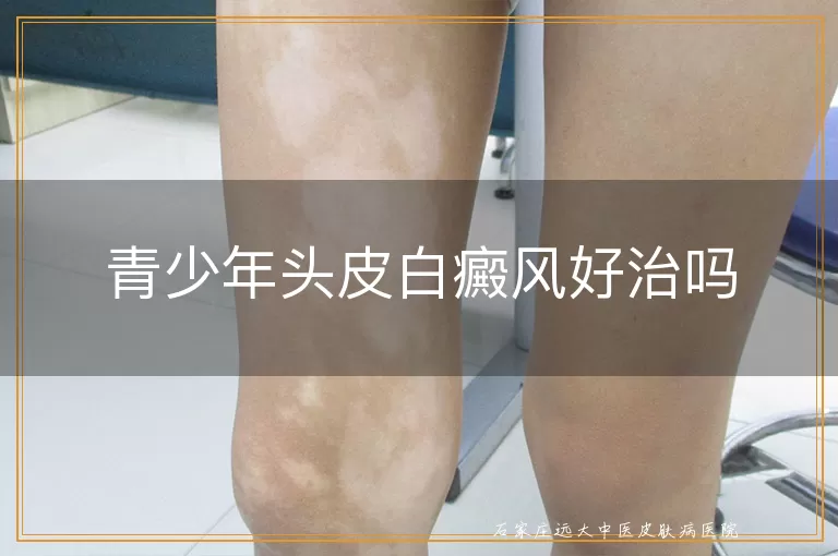 青少年头皮白癜风好治吗