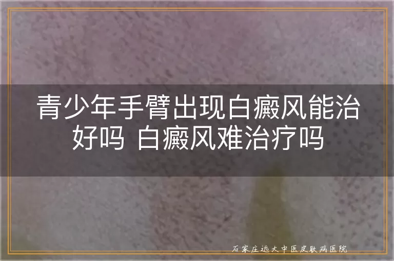 青少年手臂出现白癜风能治好吗 白癜风难治疗吗