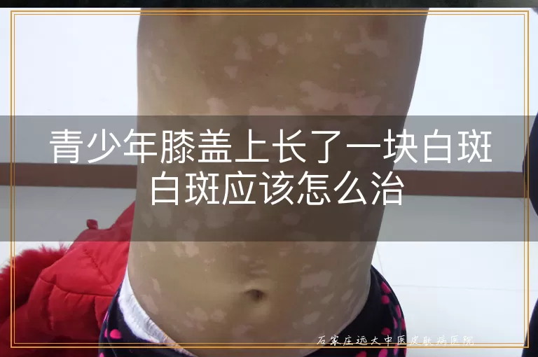 青少年膝盖上长了一块白斑 白斑应该怎么治