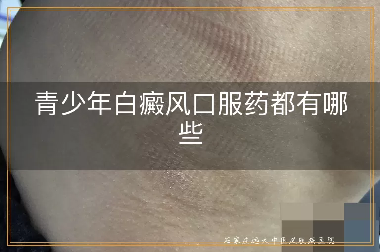 青少年白癜风口服药都有哪些