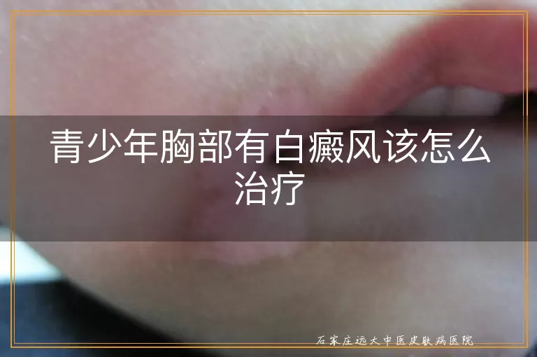 青少年胸部有白癜风该怎么治疗