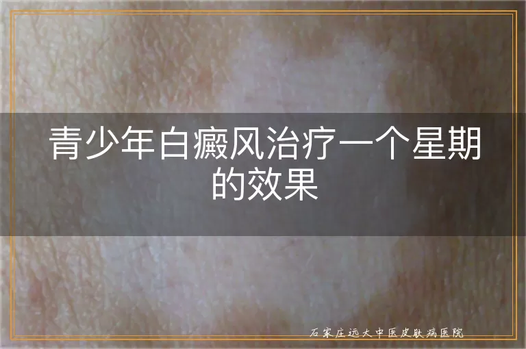 青少年白癜风治疗一个星期的效果