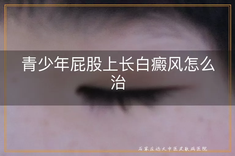 青少年屁股上长白癜风怎么治