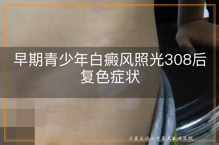 早期青少年白癜风照光308后复色症状