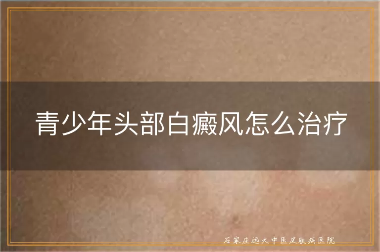 青少年头部白癜风怎么治疗