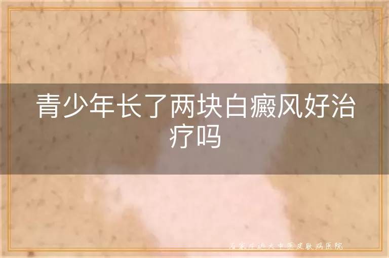 青少年长了两块白癜风好治疗吗