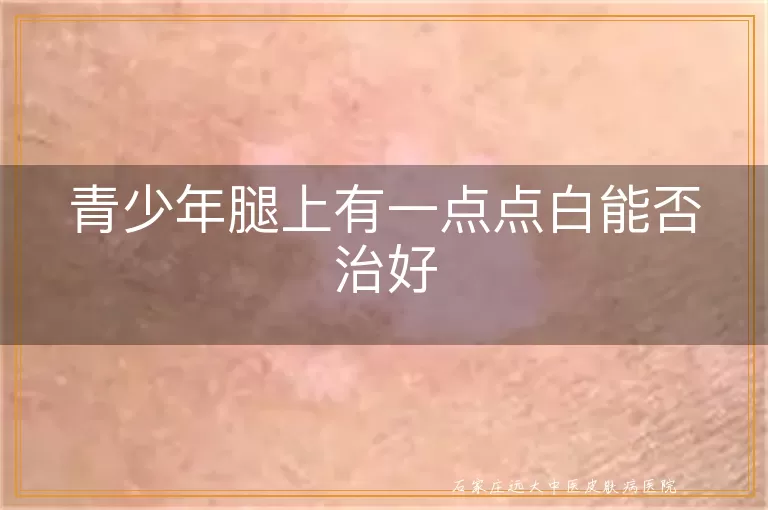 青少年腿上有一点点白能否治好