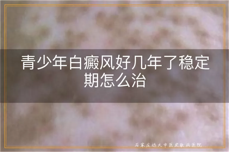 青少年白癜风好几年了稳定期怎么治
