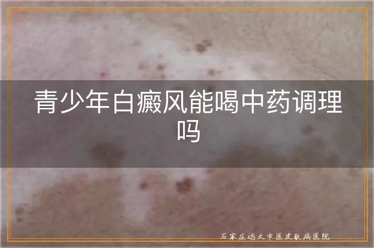 青少年白癜风能喝中药调理吗