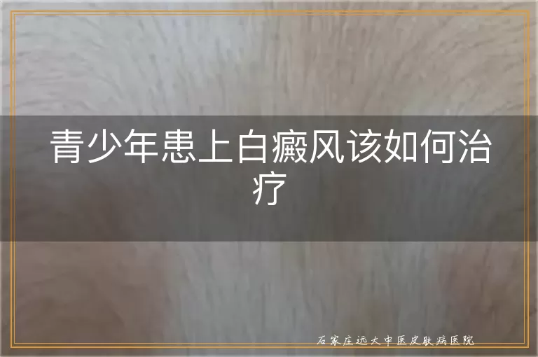 青少年患上白癜风该如何治疗