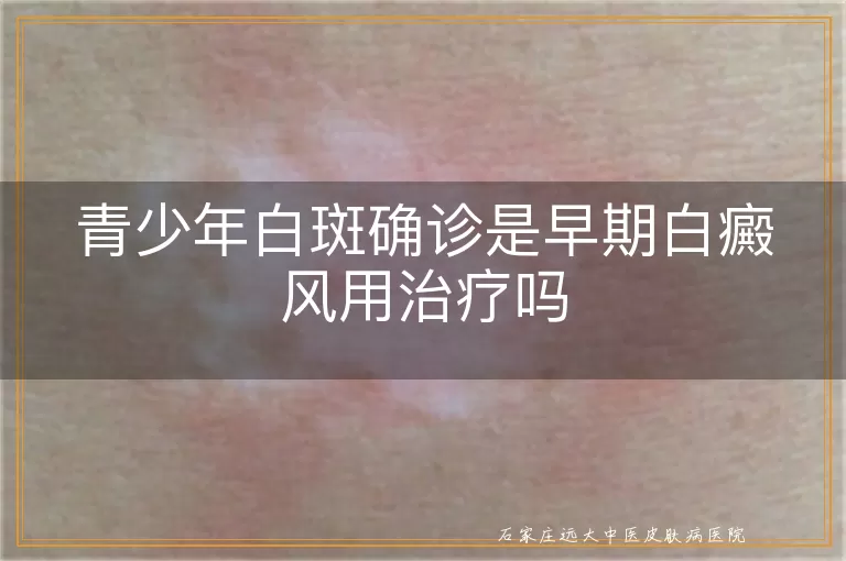 青少年白斑确诊是早期白癜风用治疗吗