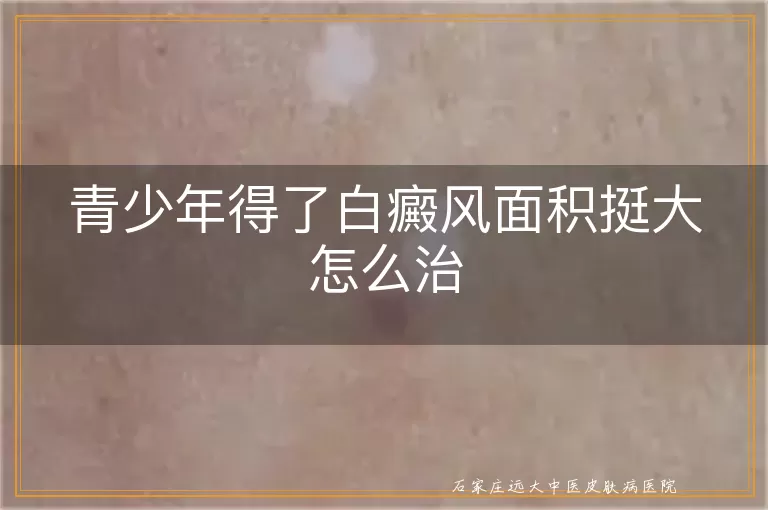 青少年得了白癜风面积挺大怎么治