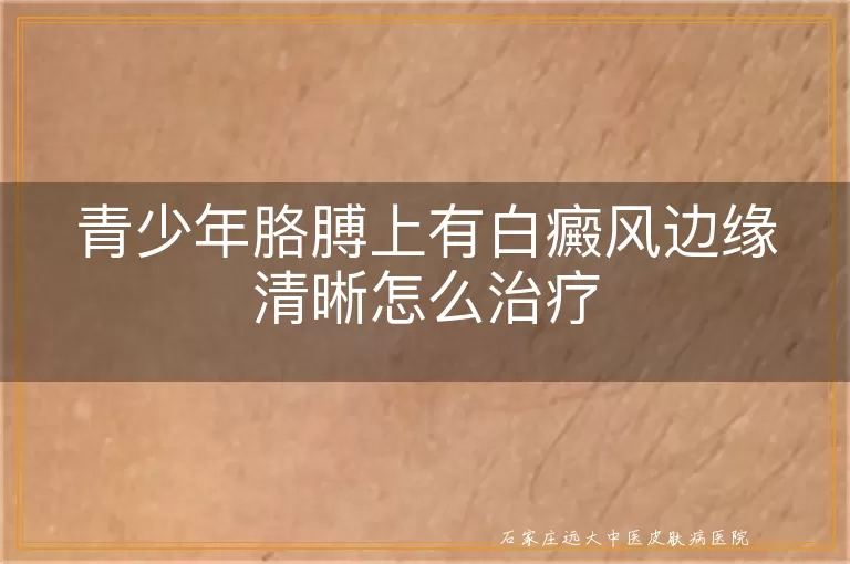 青少年胳膊上有白癜风边缘清晰怎么治疗