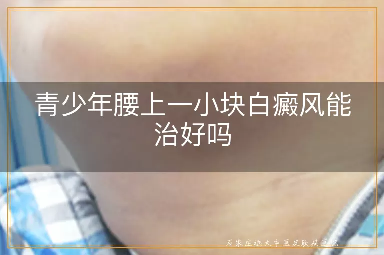 青少年腰上一小块白癜风能治好吗