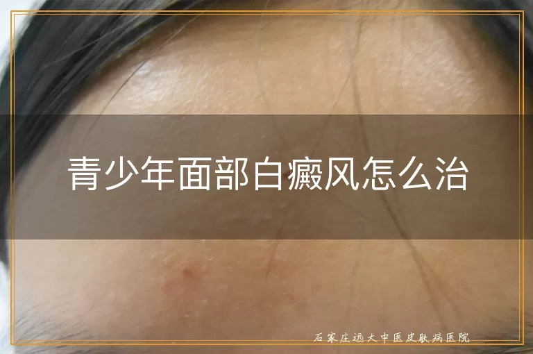 青少年面部白癜风怎么治