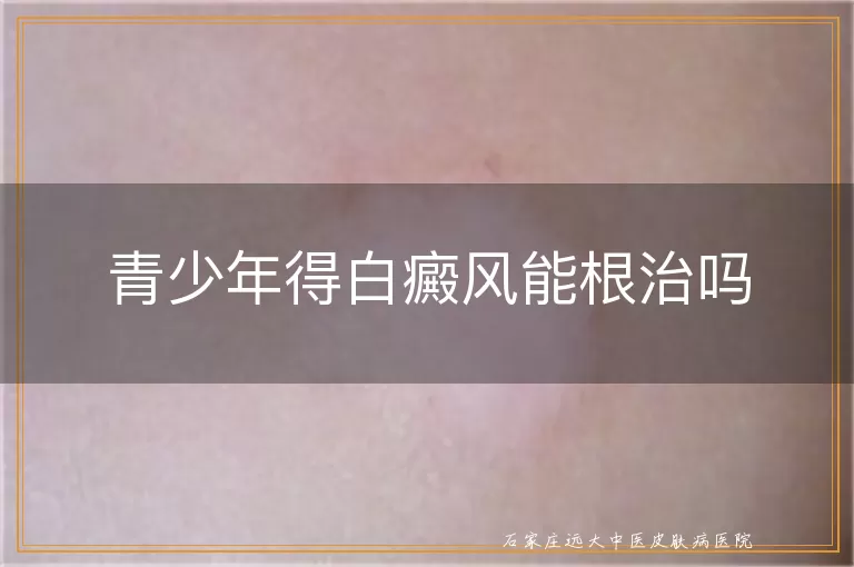 青少年得白癜风能根治吗