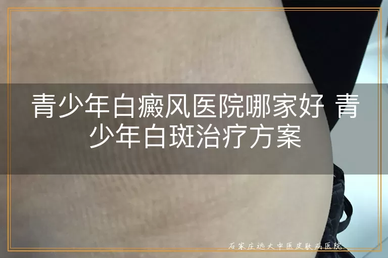青少年白癜风医院哪家好 青少年白斑治疗方案