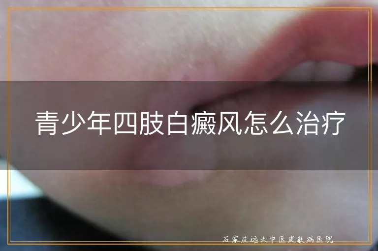 青少年四肢白癜风怎么治疗