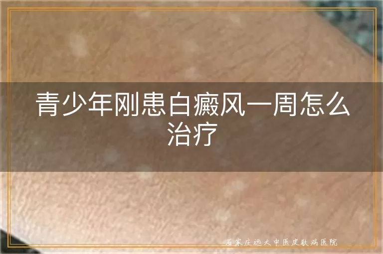 青少年刚患白癜风一周怎么治疗