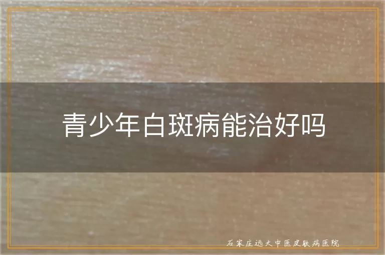 青少年白斑病能治好吗