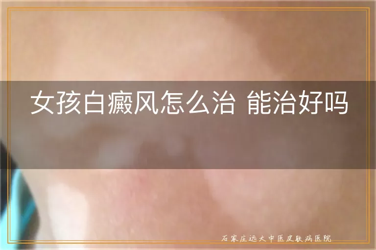 女孩白癜风怎么治 能治好吗
