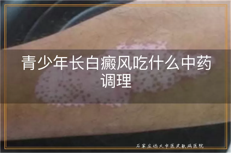 青少年长白癜风吃什么中药调理