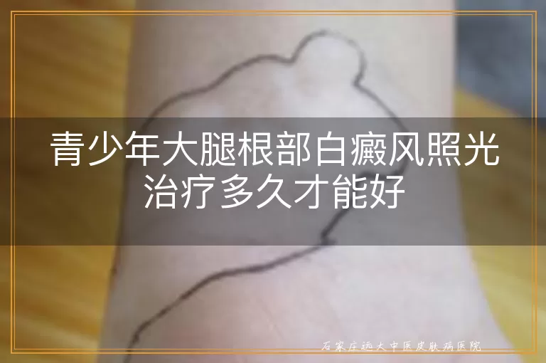 青少年大腿根部白癜风照光治疗多久才能好