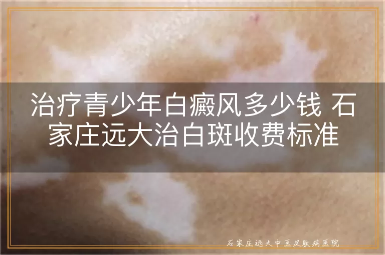 治疗青少年白癜风多少钱 石家庄远大治白斑收费标准