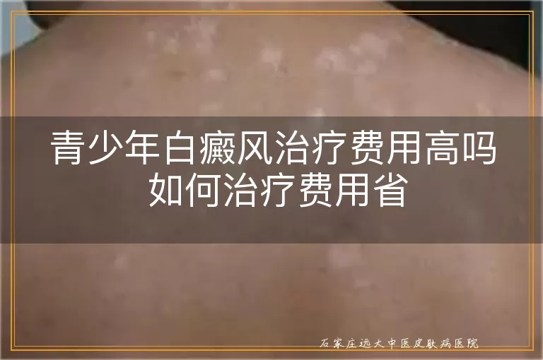 青少年白癜风治疗费用高吗 如何治疗费用省