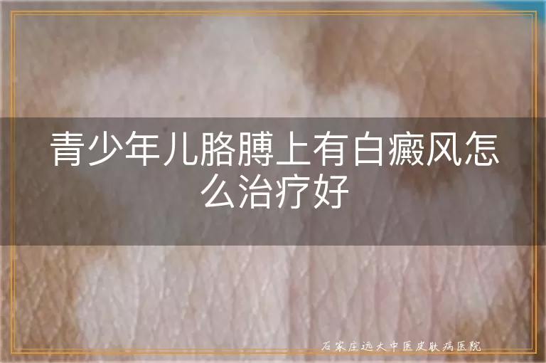 青少年儿胳膊上有白癜风怎么治疗好