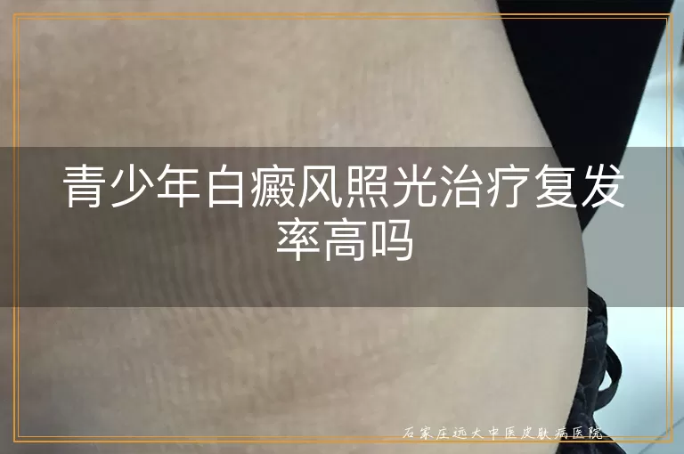 青少年白癜风照光治疗复发率高吗