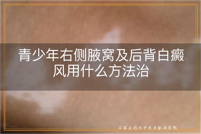 青少年右侧腋窝及后背白癜风用什么方法治