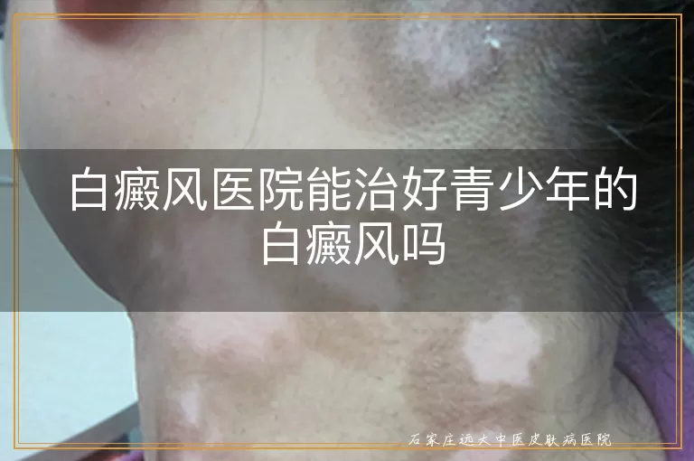 白癜风医院能治好青少年的白癜风吗