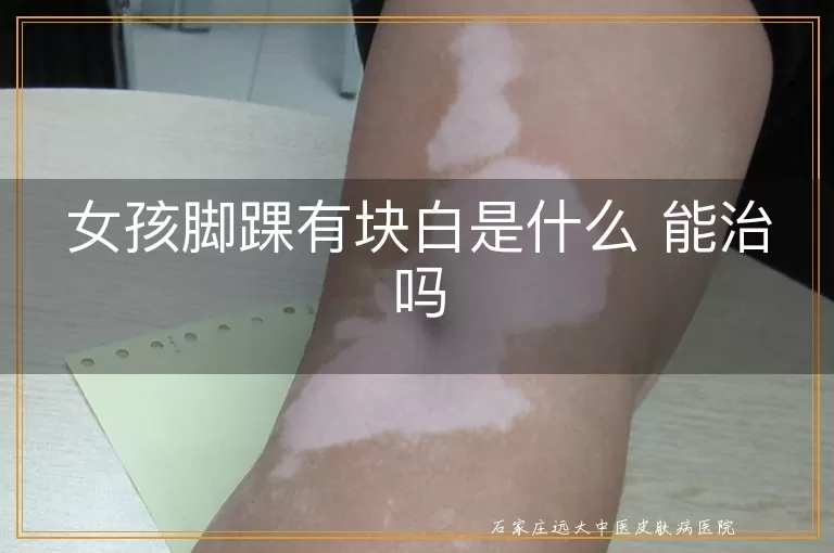 女孩脚踝有块白是什么 能治吗