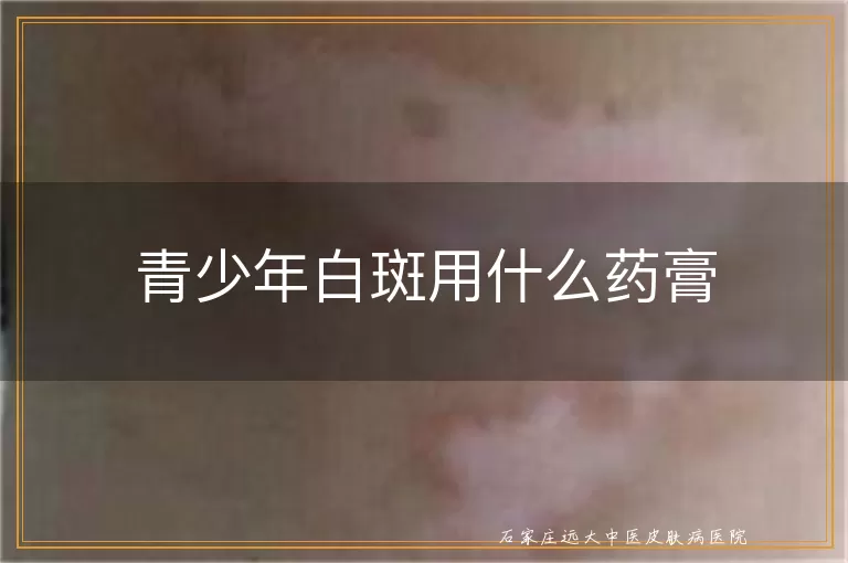 青少年白斑用什么药膏