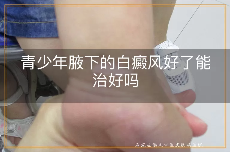青少年腋下的白癜风好了能治好吗