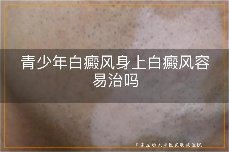 青少年白癜风身上白癜风容易治吗