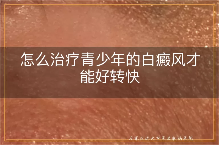 怎么治疗青少年的白癜风才能好转快