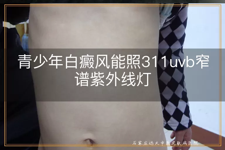 青少年白癜风能照311uvb窄谱紫外线灯