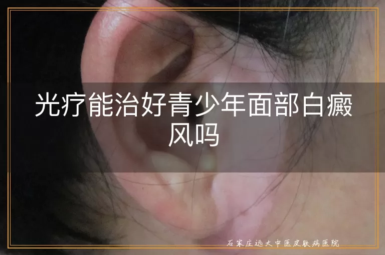 光疗能治好青少年面部白癜风吗