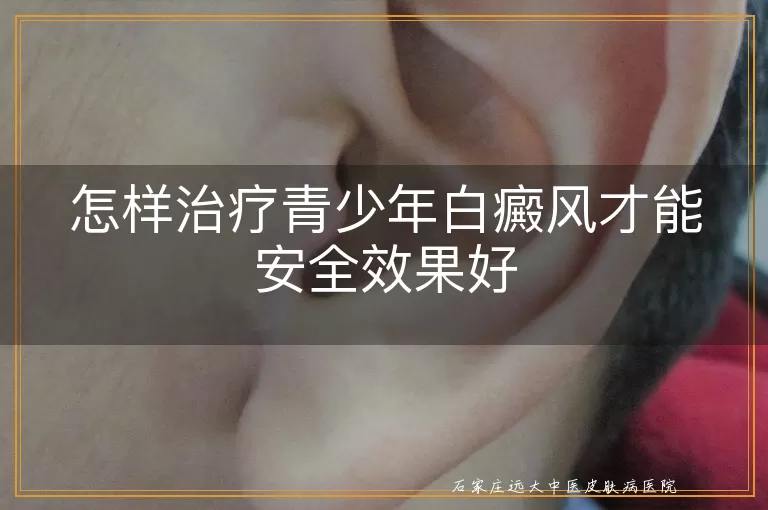 怎样治疗青少年白癜风才能安全效果好