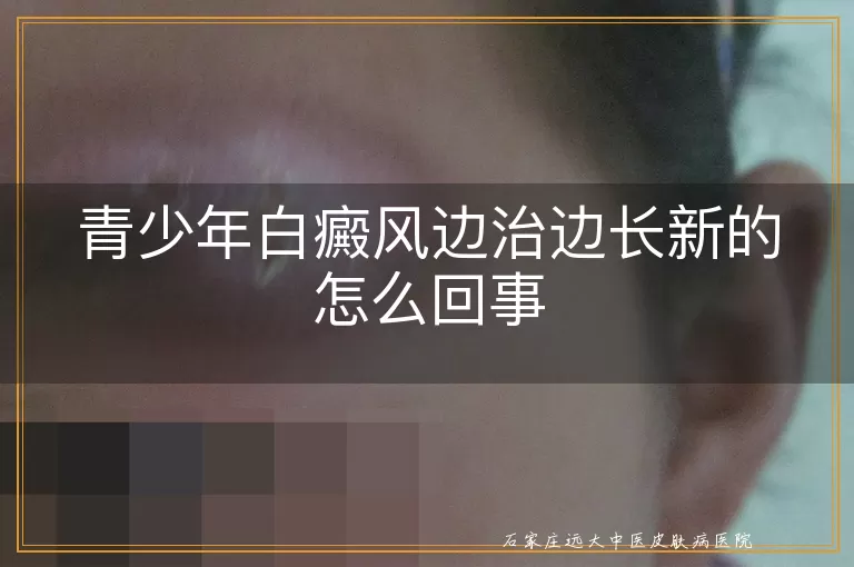 青少年白癜风边治边长新的怎么回事
