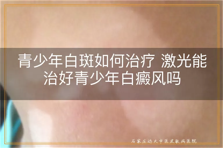 青少年白斑如何治疗 激光能治好青少年白癜风吗