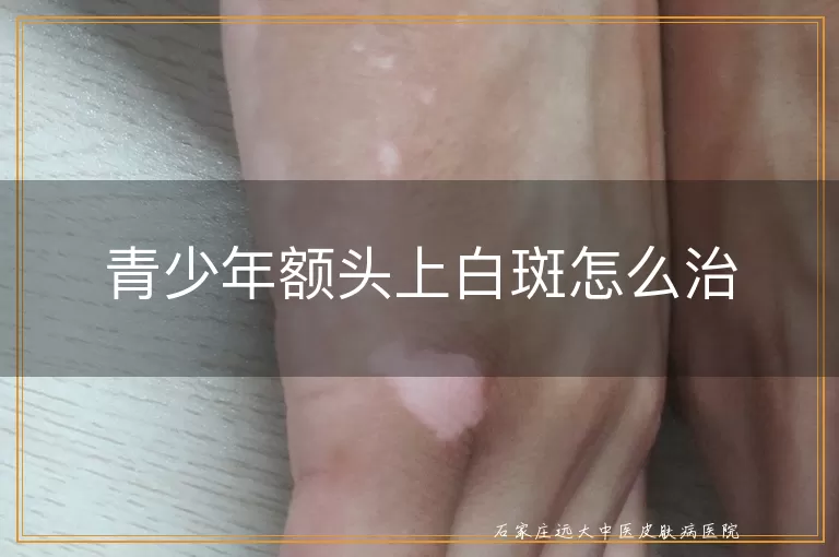 青少年额头上白斑怎么治