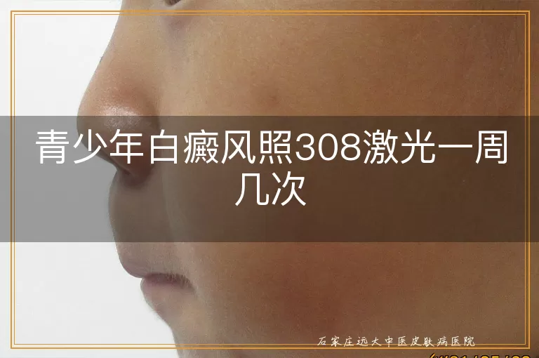青少年白癜风照308激光一周几次
