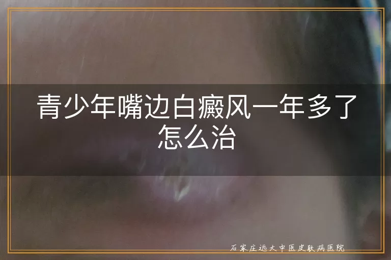 青少年嘴边白癜风一年多了怎么治