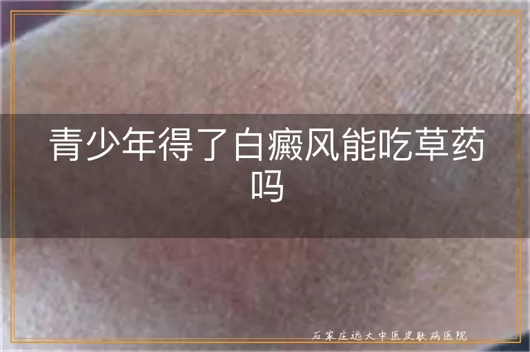 青少年得了白癜风能吃草药吗