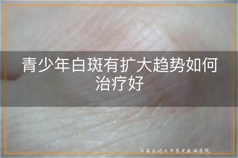 青少年白斑有扩大趋势如何治疗好